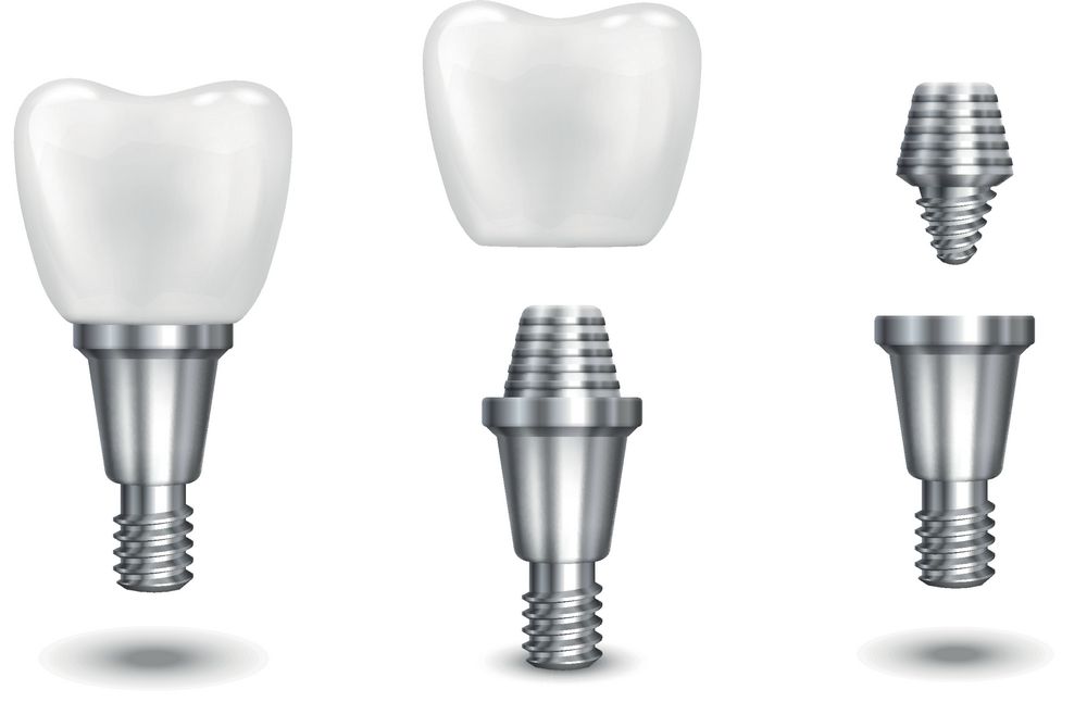 种牙好还是镶牙好区别是什么？种牙和镶牙的价格一样吗？