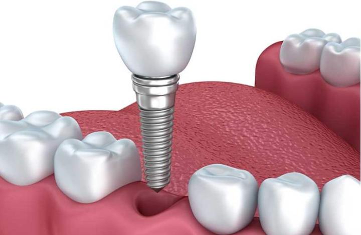 种牙好还是镶牙好区别是什么？种牙和镶牙的价格一样吗？