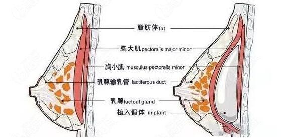 西安哪家整形医院隆胸好?求推荐西安丰胸口碑好的医院