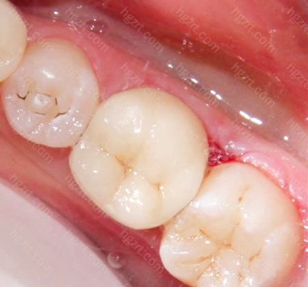 不断增多导致牙龈体积增大的一种口腔疾病