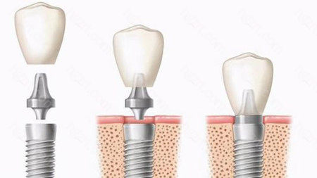 就以种植牙来说吧，私人牙科报价基本上包含了种植体、基台、牙冠以及其他杂七杂八的所有费用相加起来，一次性告诉患者整体报价以及治疗流程。而医院的收费是按照项目来收费的，比如种植体一个价格、牙冠一个价格，种植另外费用还要另算，单价看起来不是很高，实际所有费用相加起来，报价跟私人牙科相差无几。