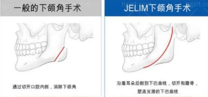 广州沈绍勇做磨骨怎么样