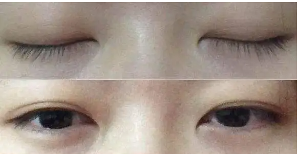 肿眼泡怎样改善 肿眼泡怎样改善