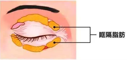 肿眼泡怎样改善 肿眼泡怎样改善