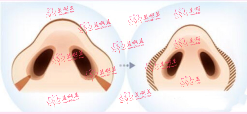 鼻翼内切原理