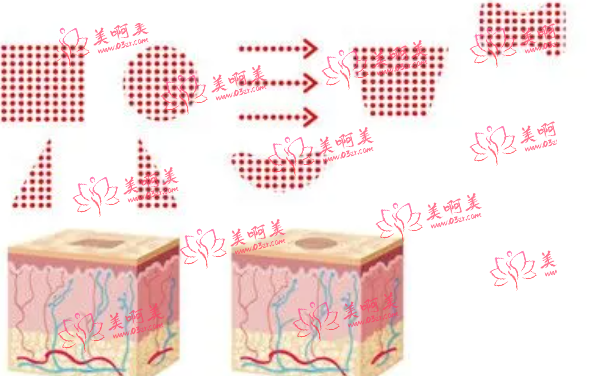 安徽省点阵激光是怎么收费的？它的价格影响因素是什么？