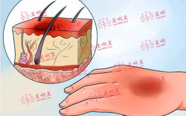 安徽省点阵激光是怎么收费的？它的价格影响因素是什么？