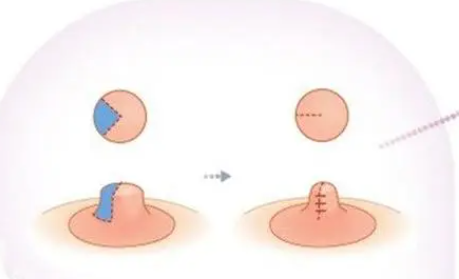 肇庆市乳晕缩小矫正手术医生实力口碑top10榜单公开-于立民医生包揽前四强