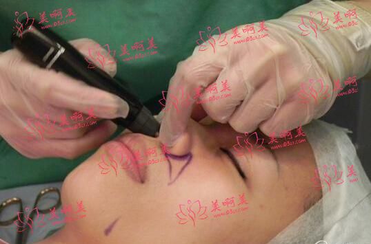 韩式鼻部整形手术矫正怎样术后护理应该怎样做？需要注意什么？