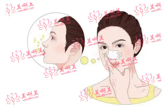 韩式鼻部整形手术矫正怎样术后护理应该怎样做？需要注意什么？