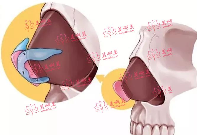 2023年吉安市鼻缺损修复整形医院,鼻缺损修复相关疑惑解答