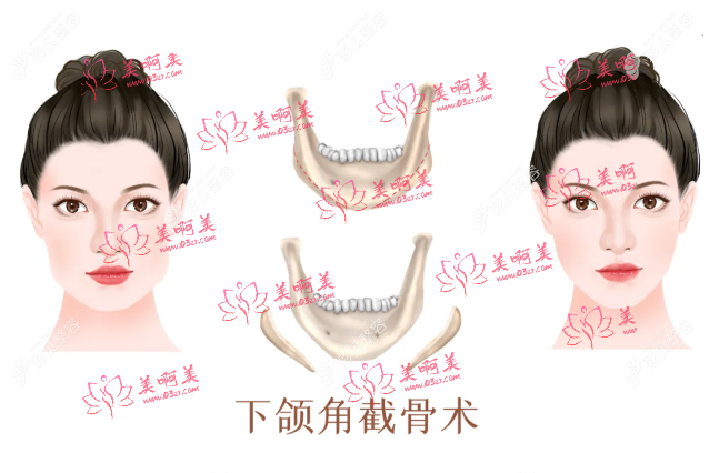 国字脸磨骨风险大吗？