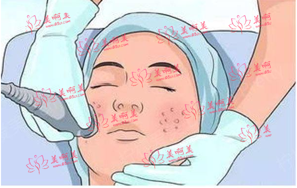 长斑的原因是什么？有什么快速有效地祛斑方法吗？