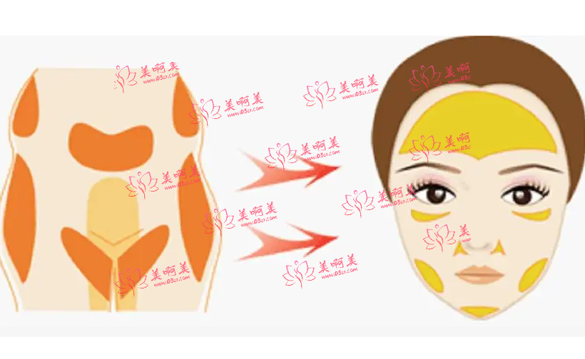 面颊凹陷太显老,快来试试脂肪填充吧 面颊凹陷太显老,快来试试脂肪填充吧