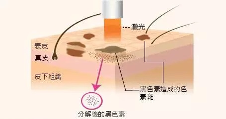 贵阳激光祛斑哪个医院榜单公开？华美紫馨/美莱/美贝尔通通上榜