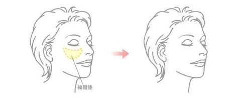 去颊脂垫手术安全吗？影响价格的因素是什么？