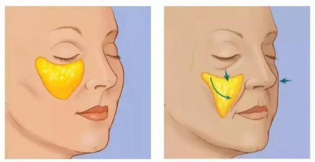 襄阳苹果肌填充脸部手术费用、作用、丰脸颊的方法
