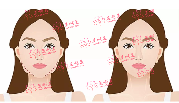 什么是溶脂瘦脸？邯郸做溶脂瘦身技术口碑好的医院有哪些？