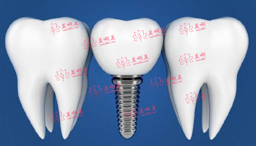 武汉种牙最新价格表，德韩/牙达人/大众口腔等都是好医院!