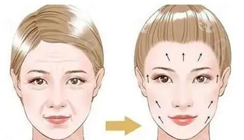 魔法超拉皮可以维持多久?影响价格的因素有哪些? 魔法超拉皮可以维持多久?影响价格的因素有哪些?