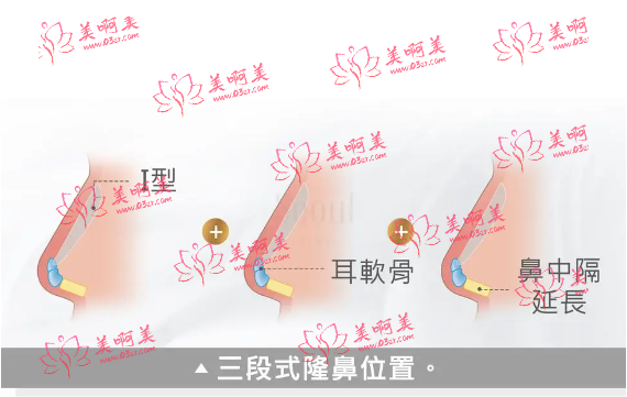 义三段式硅胶隆鼻手术价格贵吗？与什么因素有关？