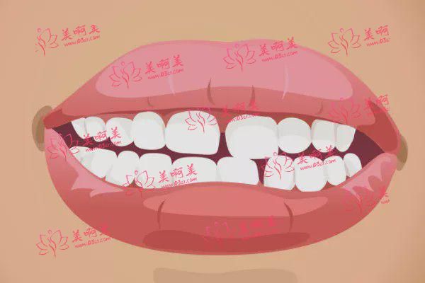 牙齿缝隙大有什么好的方法吗？怎样保持口腔健康？