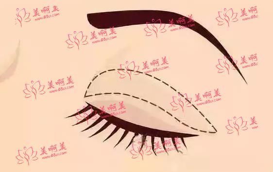 上海五官科医院医生技术介绍&做双眼皮手术价格分享