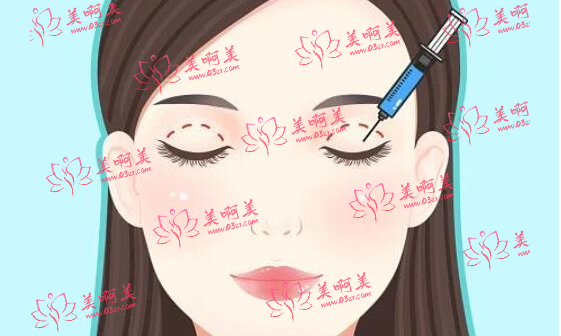 上海玫瑰双眼皮修复怎么样？邹功伟医生经验丰富技术好！附双眼皮修复价格表