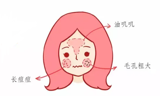 油性皮肤应该怎样选择护肤品？先来看看油皮的特点吧！