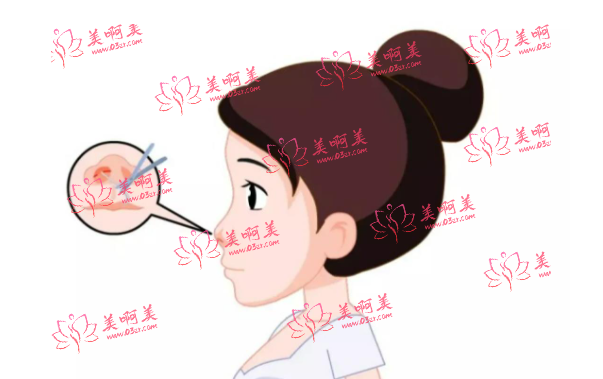 超肋鼻30000价格合理吗?影响费用的因素有哪些?维持时间多久? 超肋鼻30000价格合理吗?影响费用的因素有哪些?维持时间多久?