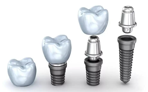 牙桩选择纯钛桩还是纤维桩？牙桩的适应症状一览！