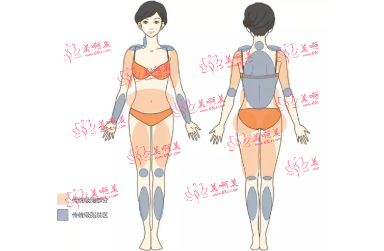 全身抽脂价格贵吗？单词抽脂有量的限制，恢复期有多久？快来速览！