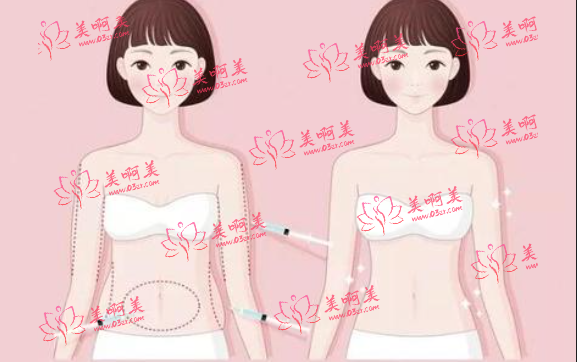 全身抽脂价格贵吗？单词抽脂有量的限制，恢复期有多久？快来速览！