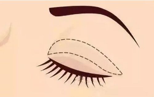 北京博兰光泽双眼皮怎么样？要多少钱？客户评语很不错！