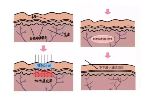 光子嫩肤价格一般是多少?盘点光子嫩肤的优缺点! 光子嫩肤价格一般是多少?盘点光子嫩肤的优缺点!