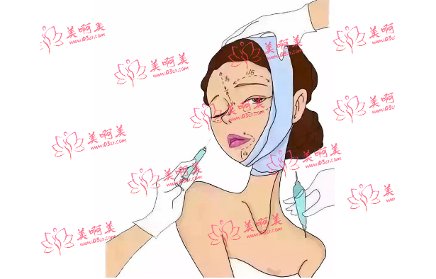 广州美莱玻尿酸注射注意事项，玻尿酸价格、技术优势一览！