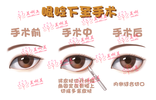北京眼睑下至手术好的医院推荐：华韩、美莱、克莱美舍、美媛荟都是靠谱的选择！
