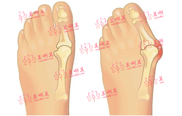 上海虹桥医院介绍：做拇外翻手术人气很高，医生实力不可小觑！