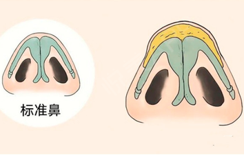 上海地区缩小鼻翼鼻头手术价格参照！当地热门医院收费情况对比！