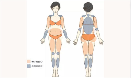 郑州缔莱美全身吸脂收费贵不贵？1w起步价格合理，附医院介绍