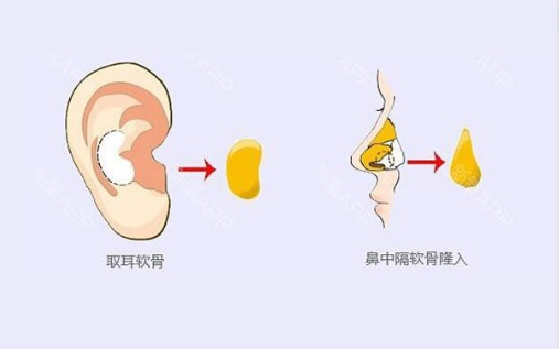 耳软骨隆鼻和肋骨隆鼻哪一种比较好？两种方法多方面对比