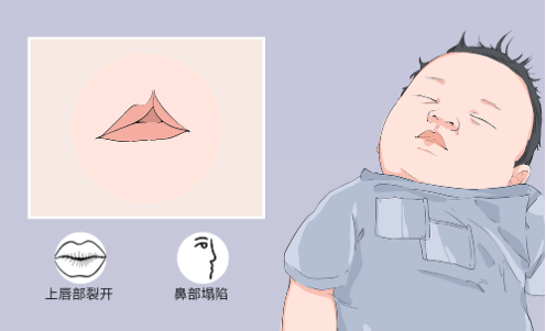 上海九院做唇腭裂手术怎么样？实力医生王健值得推荐！