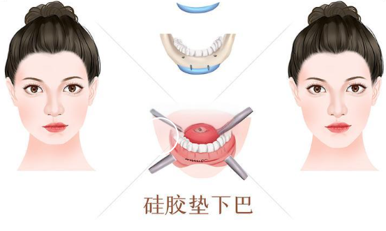 假体垫下巴多久可以定型，垫下巴以后需要怎么护理?