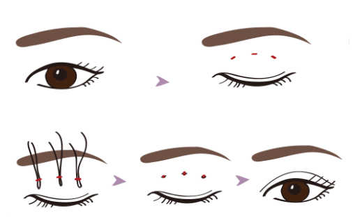 三点定位双眼皮手术：优点与缺点的探讨