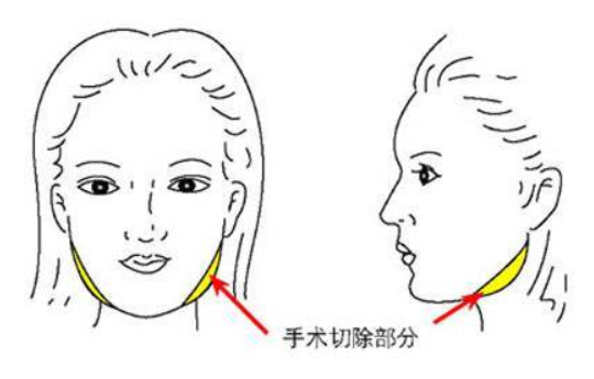 颧骨整形手术有哪些适应症