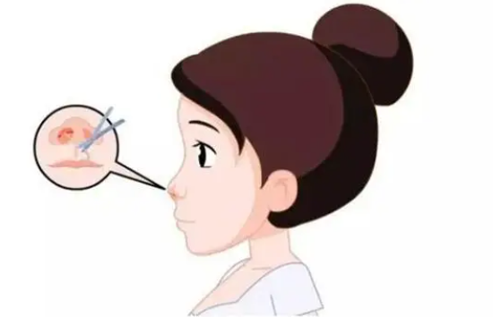 膨体隆鼻手术的安全性怎么样?