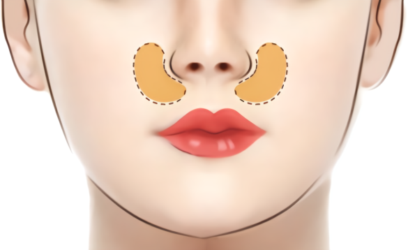 鼻基底填充的方法有哪些？