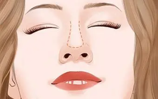 鼻尖整形常见的三种方法