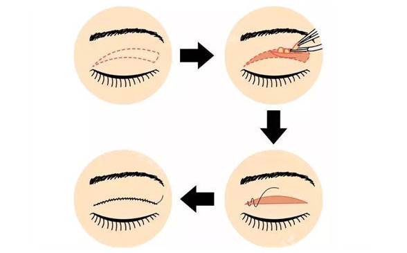 全切双眼皮与埋线双眼皮：哪个更适合你?