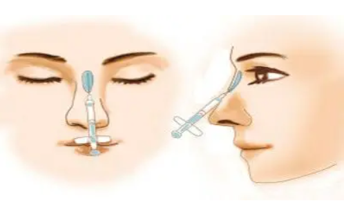 注射隆鼻有几种材料?假体隆鼻的话效果可以保持多久?